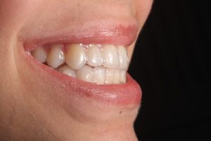 ortodontia alinhadores