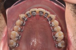 ortodontia aparelho lingual